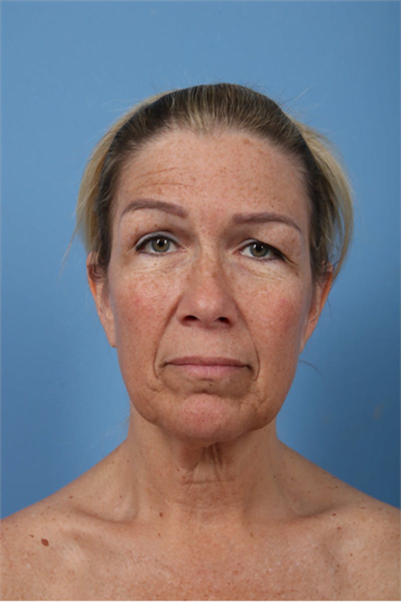 Neck Lift Before & After Gallery - Patient 393253 - Image 1