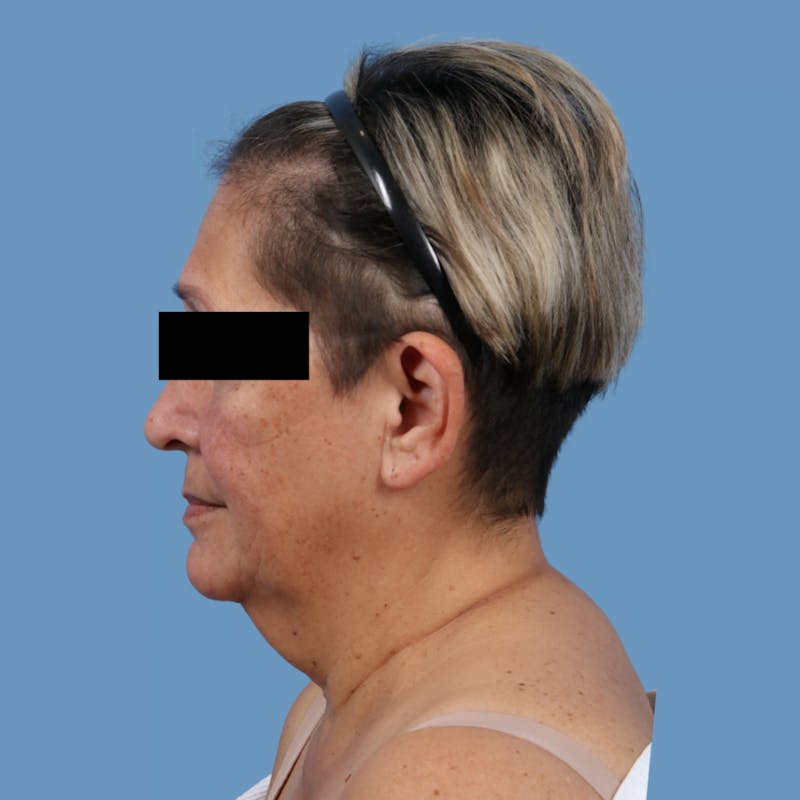 Neck Lift Before & After Gallery - Patient 130082 - Image 3
