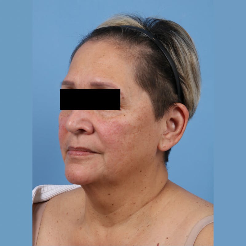 Neck Lift Before & After Gallery - Patient 130082 - Image 1