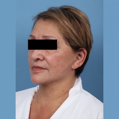 Neck Lift Before & After Gallery - Patient 130082 - Image 2