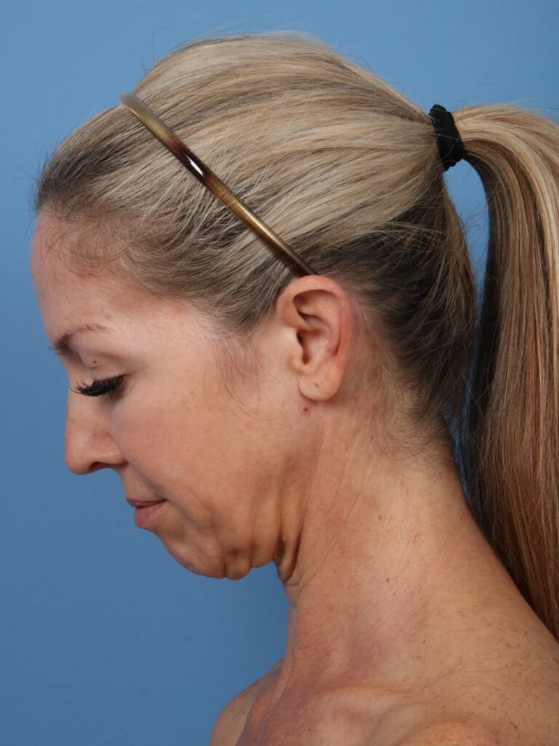 Neck Lift Before & After Gallery - Patient 332682 - Image 3