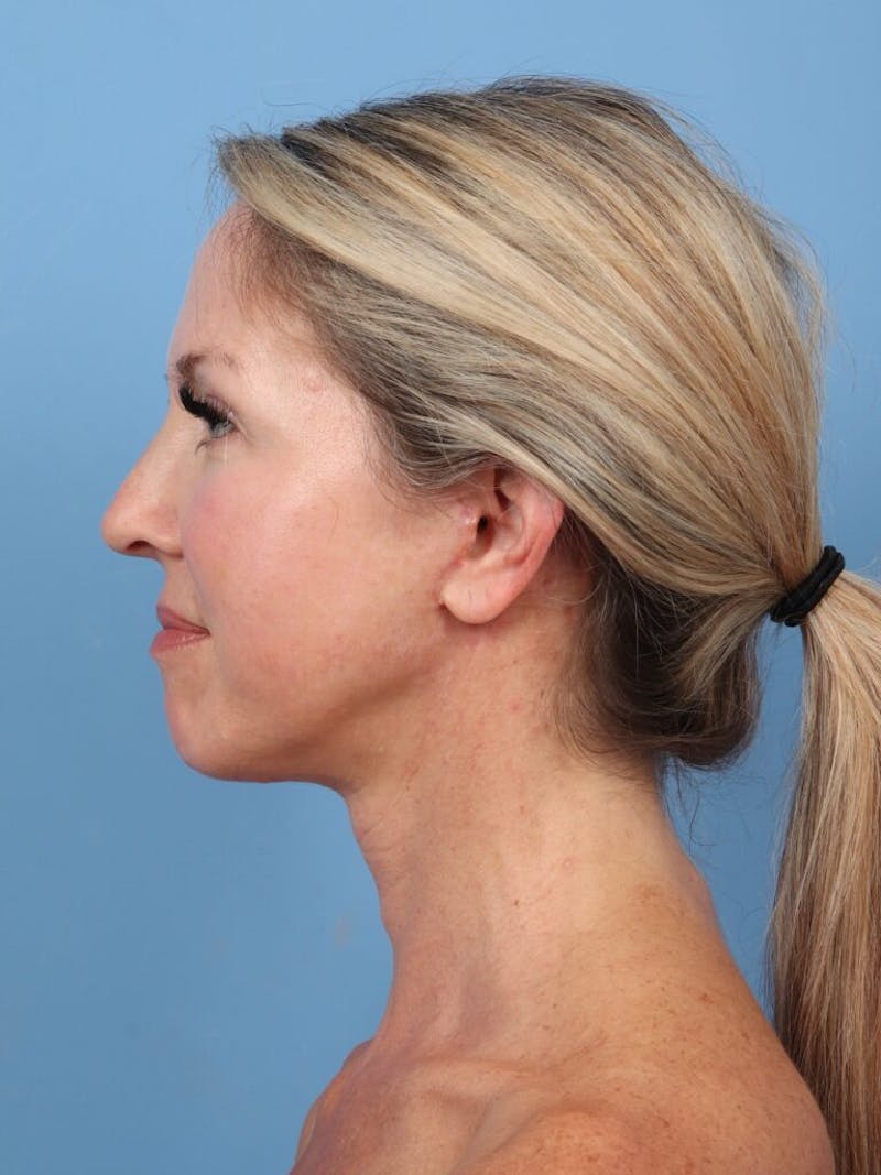 Neck Lift Before & After Gallery - Patient 332682 - Image 6