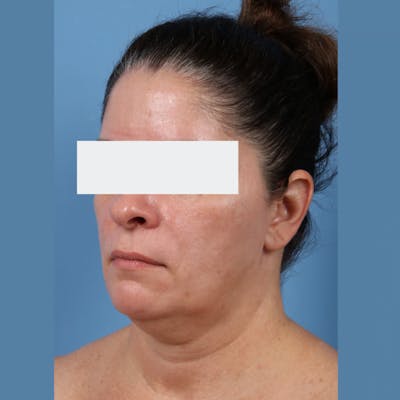 Neck Lift Before & After Gallery - Patient 154525 - Image 1