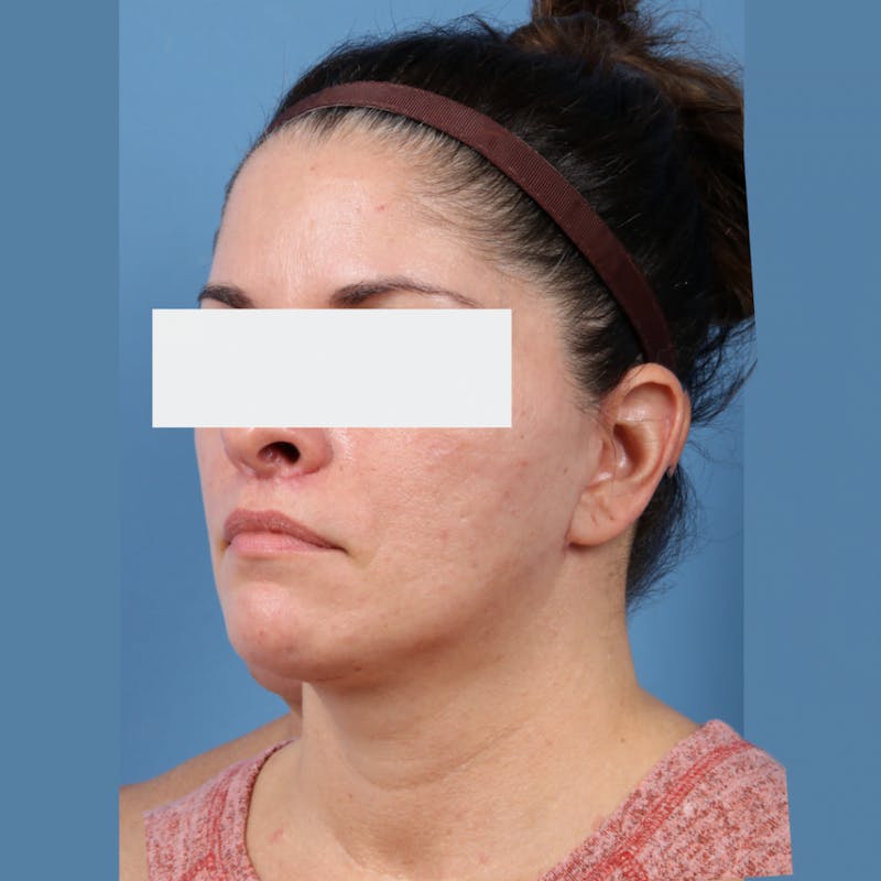 Neck Lift Before & After Gallery - Patient 154525 - Image 2