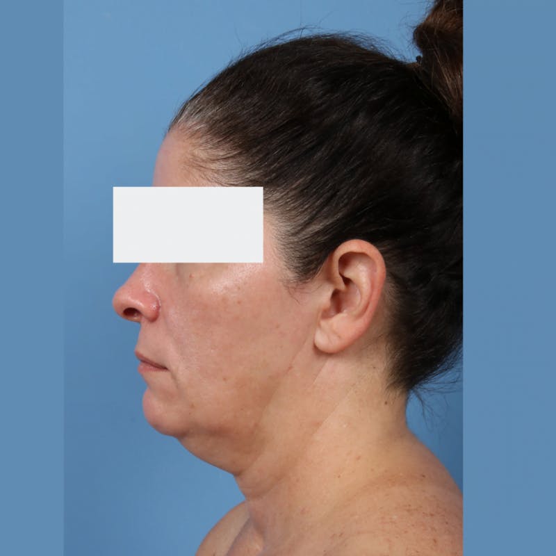 Neck Lift Before & After Gallery - Patient 154525 - Image 3
