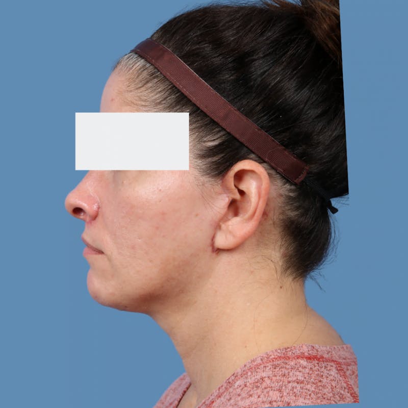 Neck Lift Before & After Gallery - Patient 154525 - Image 4