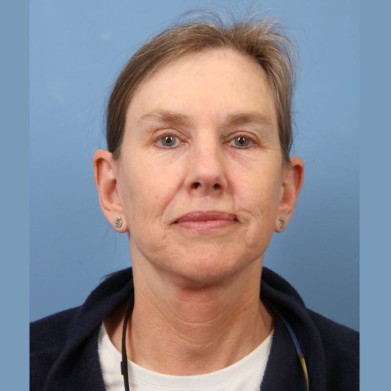 Neck Lift Before & After Gallery - Patient 115347 - Image 4