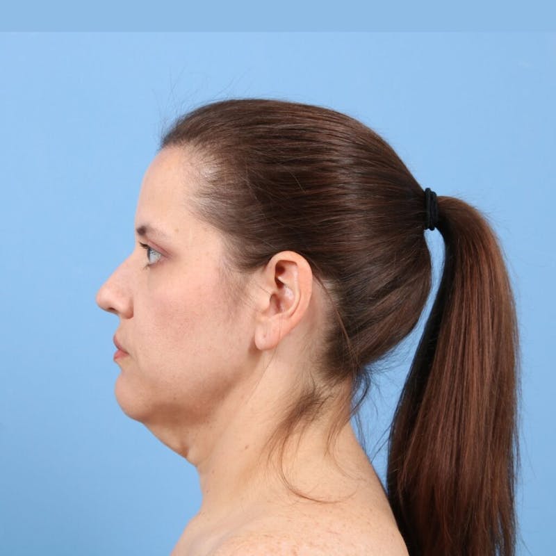 Neck Lift Before & After Gallery - Patient 351484 - Image 3
