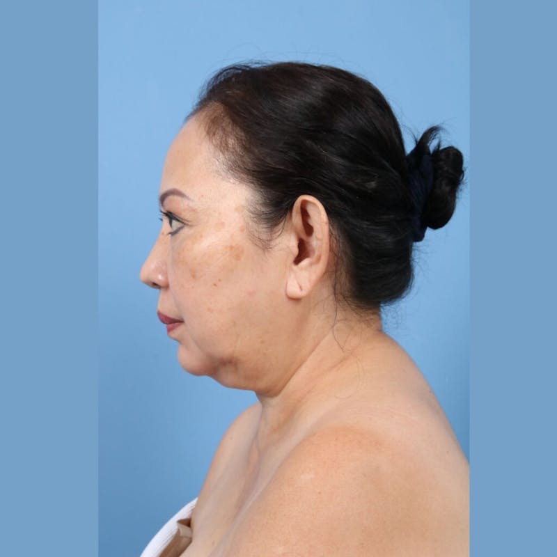 Neck Lift Before & After Gallery - Patient 300657 - Image 3