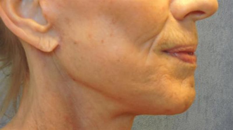 Neck Lift Before & After Gallery - Patient 173406 - Image 2