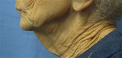 Neck Lift Before & After Gallery - Patient 374745 - Image 1
