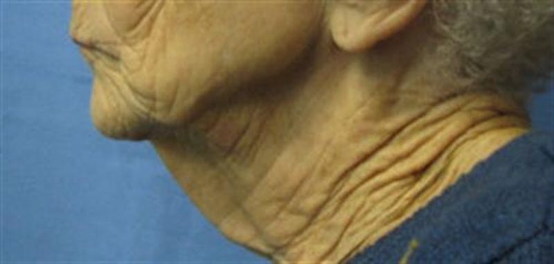Neck Lift Before & After Gallery - Patient 374745 - Image 1