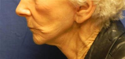 Neck Lift Before & After Gallery - Patient 374745 - Image 2