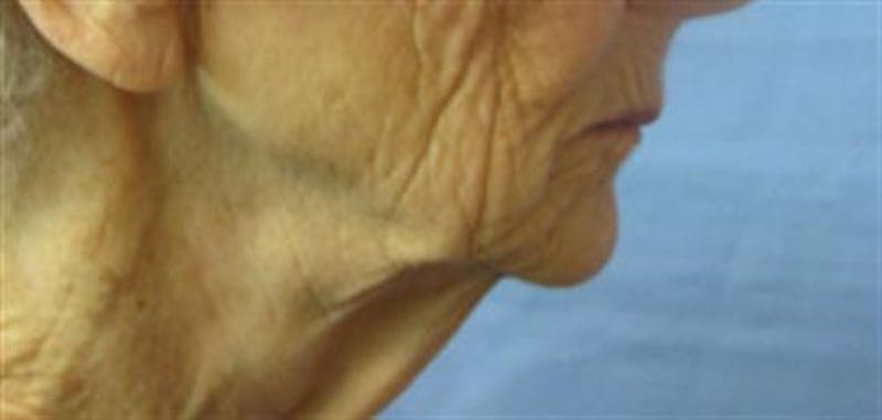Neck Lift Before & After Gallery - Patient 374745 - Image 3