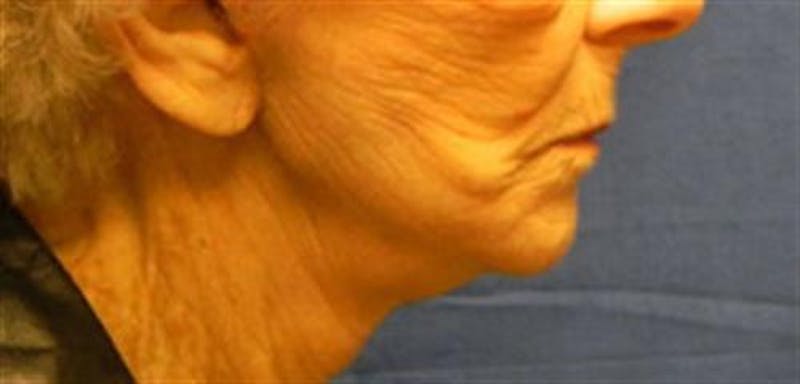 Neck Lift Before & After Gallery - Patient 374745 - Image 4