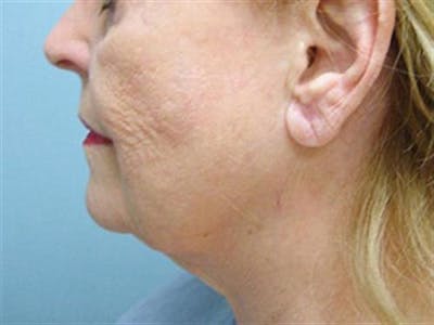 Neck Lift Before & After Gallery - Patient 336283 - Image 1