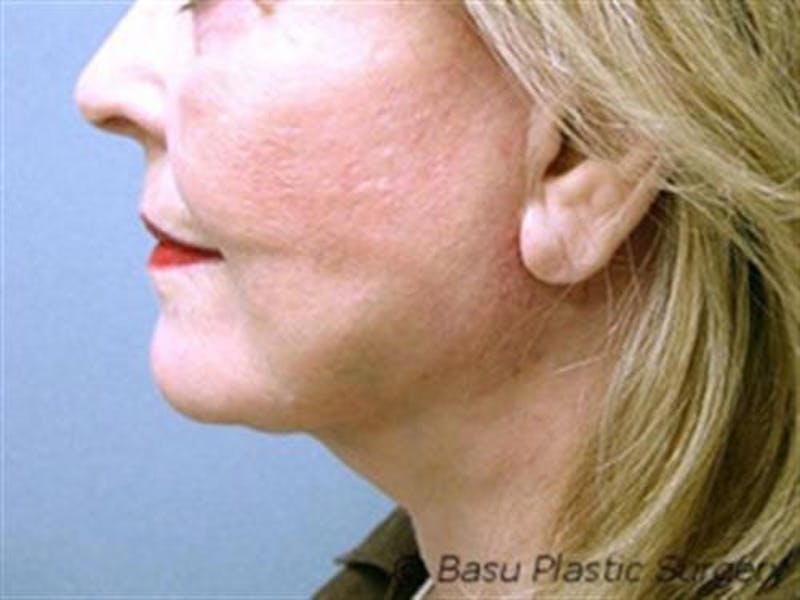 Neck Lift Before & After Gallery - Patient 336283 - Image 2