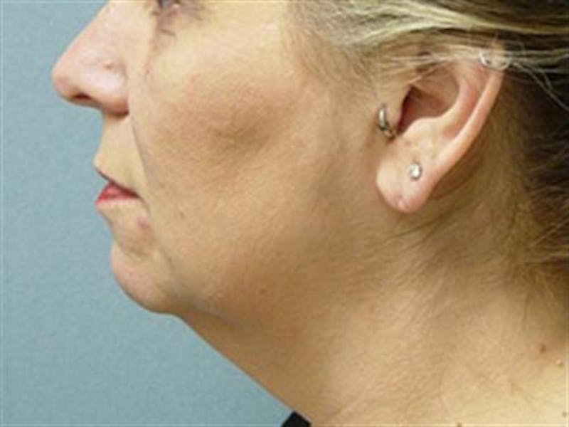 Neck Lift Before & After Gallery - Patient 952167 - Image 1