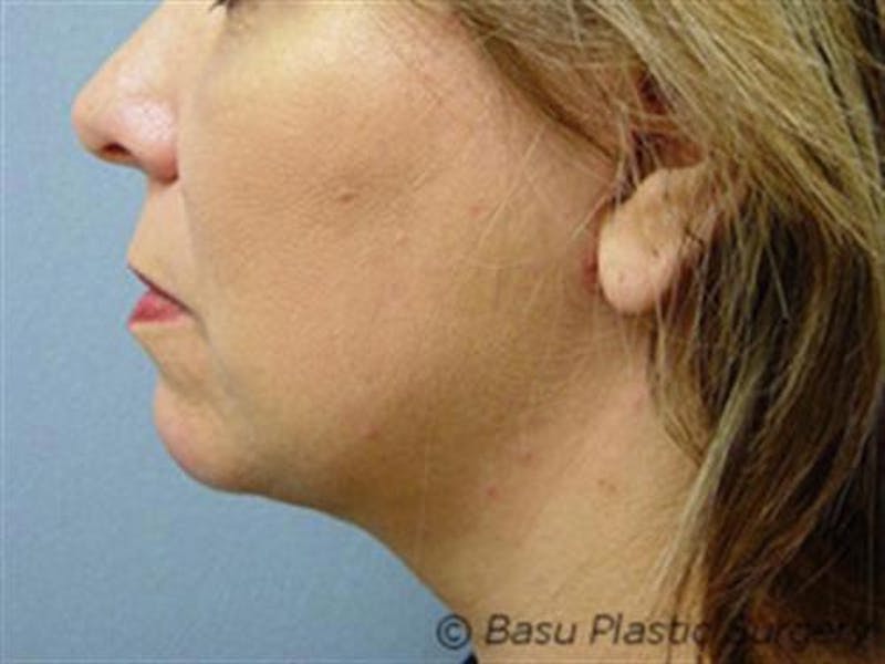 Neck Lift Before & After Gallery - Patient 952167 - Image 2