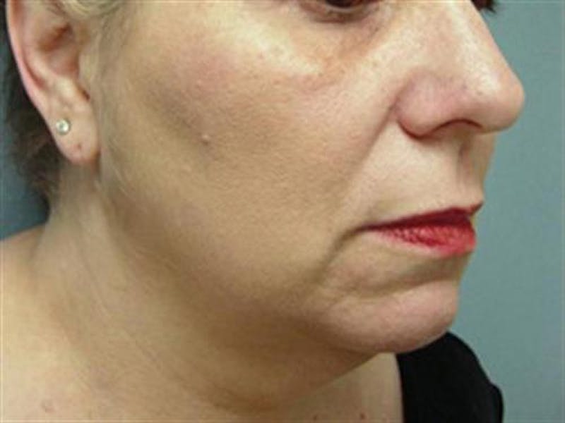 Neck Lift Before & After Gallery - Patient 952167 - Image 3