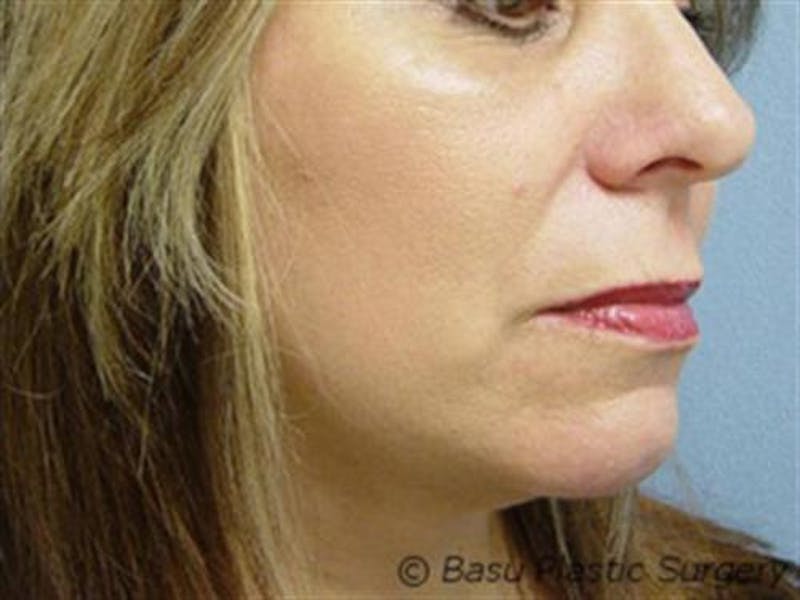 Neck Lift Before & After Gallery - Patient 952167 - Image 4