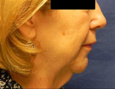 Neck Lift Before & After Gallery - Patient 945758 - Image 1