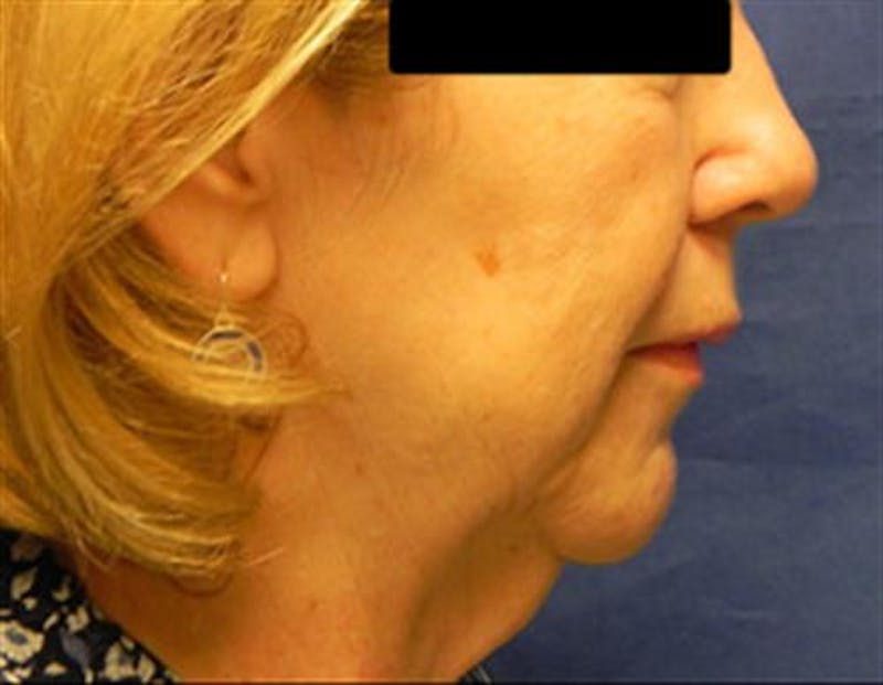 Neck Lift Before & After Gallery - Patient 945758 - Image 1