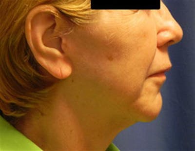 Neck Lift Before & After Gallery - Patient 945758 - Image 2