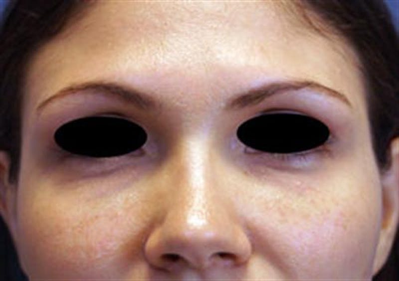 Facial Fat Micrografting Before & After Gallery - Patient 112612 - Image 1