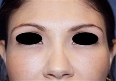 Facial Fat Micrografting Before & After Gallery - Patient 112612 - Image 2