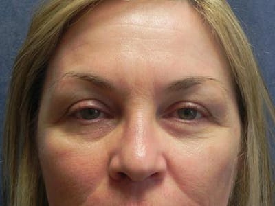 Facial Fat Micrografting Before & After Gallery - Patient 215445 - Image 1