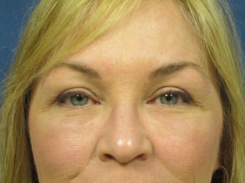 Facial Fat Micrografting Before & After Gallery - Patient 215445 - Image 2
