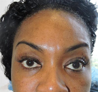 Facial Fat Micrografting Before & After Gallery - Patient 301898 - Image 1