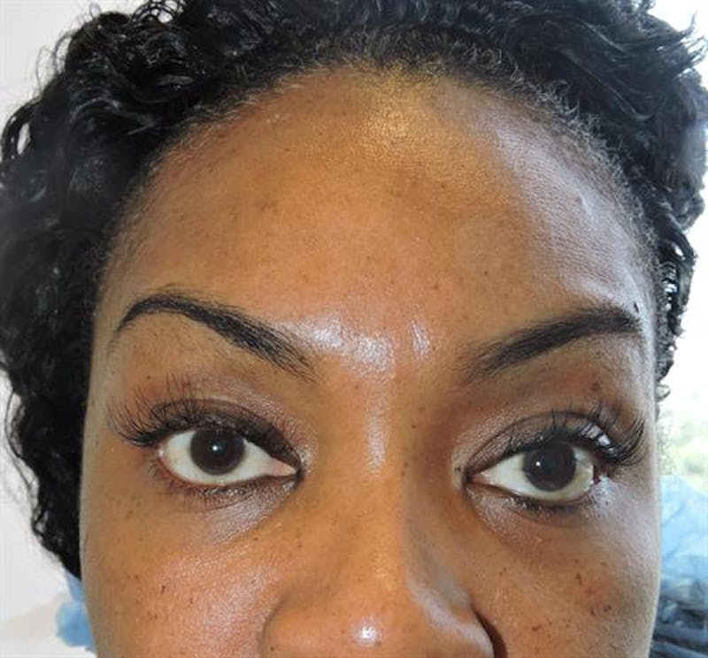 Facial Fat Micrografting Before & After Gallery - Patient 301898 - Image 1