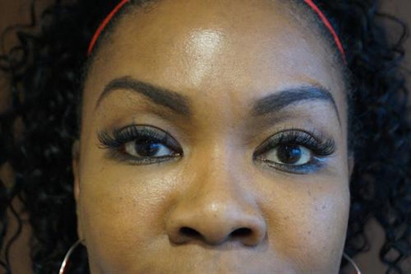 Facial Fat Micrografting Before & After Gallery - Patient 301898 - Image 2