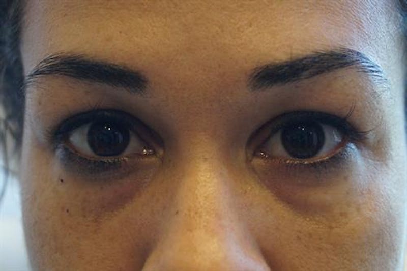 Facial Fat Micrografting Before & After Gallery - Patient 123057 - Image 1