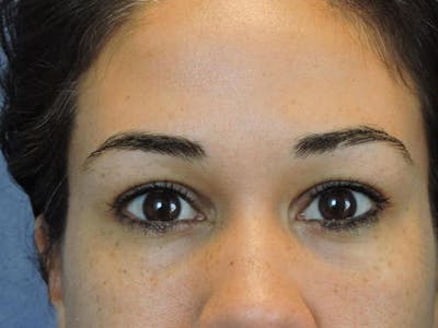 Facial Fat Micrografting Before & After Gallery - Patient 123057 - Image 2