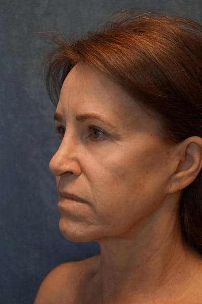 Facial Fat Micrografting Before & After Gallery - Patient 201286 - Image 1