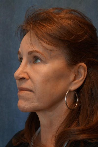 Facial Fat Micrografting Before & After Gallery - Patient 201286 - Image 2