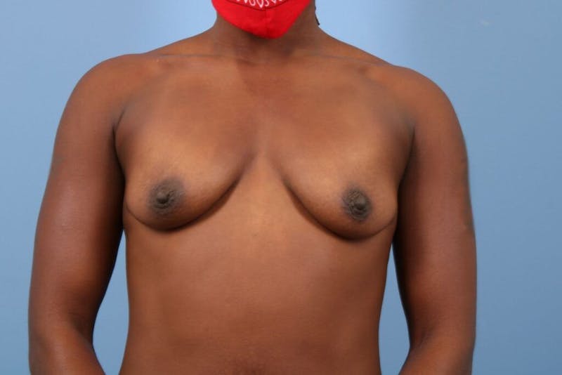 Breast Augmentation Before & After Gallery - Patient 274037 - Image 1