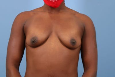Breast Augmentation Before & After Gallery - Patient 274037 - Image 1