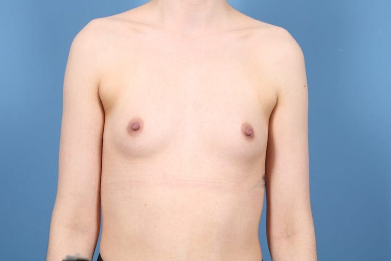 Breast Augmentation Before & After Gallery - Patient 140712 - Image 1