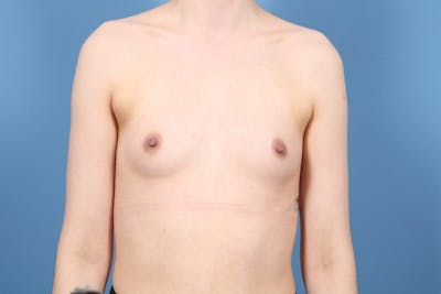 Breast Augmentation Before & After Gallery - Patient 140712 - Image 1