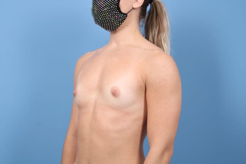 Breast Augmentation Before & After Gallery - Patient 395372 - Image 3