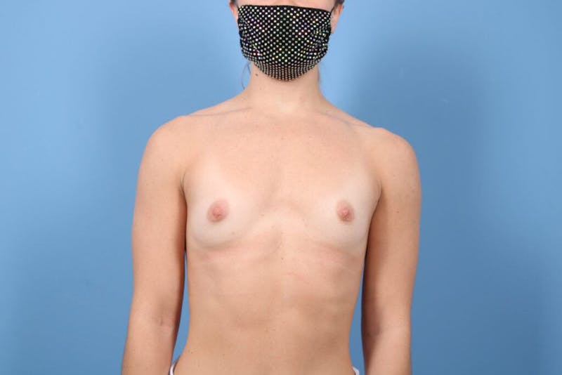 Breast Augmentation Before & After Gallery - Patient 395372 - Image 1
