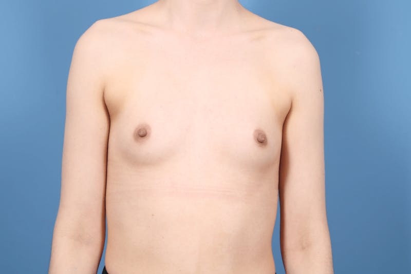 Breast Augmentation Before & After Gallery - Patient 206950 - Image 1