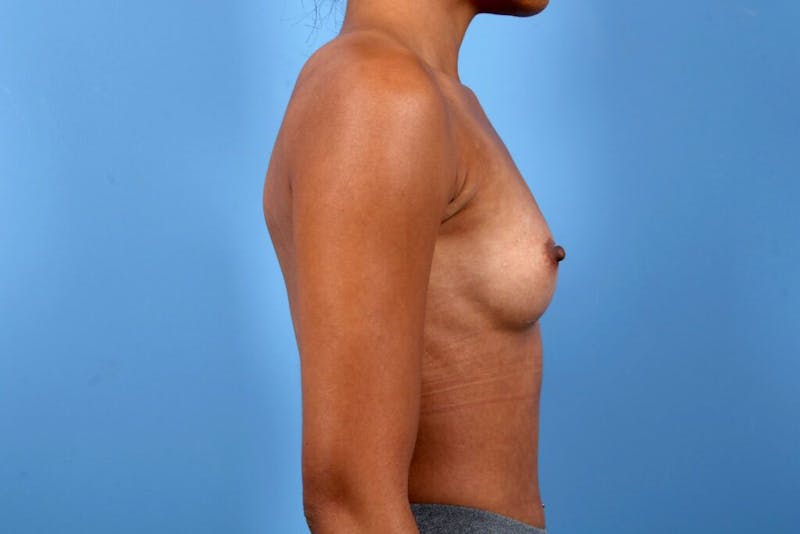 Breast Augmentation Before & After Gallery - Patient 796666 - Image 3