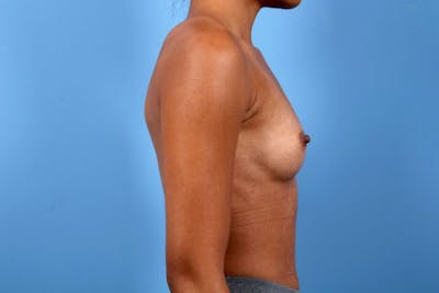 Breast Augmentation Before & After Gallery - Patient 796666 - Image 1