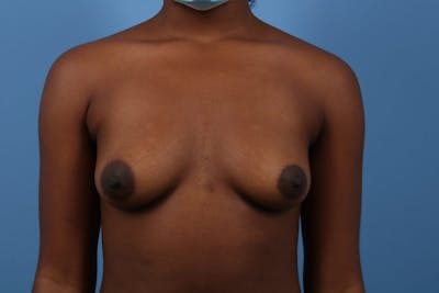 Breast Augmentation Before & After Gallery - Patient 427034 - Image 1