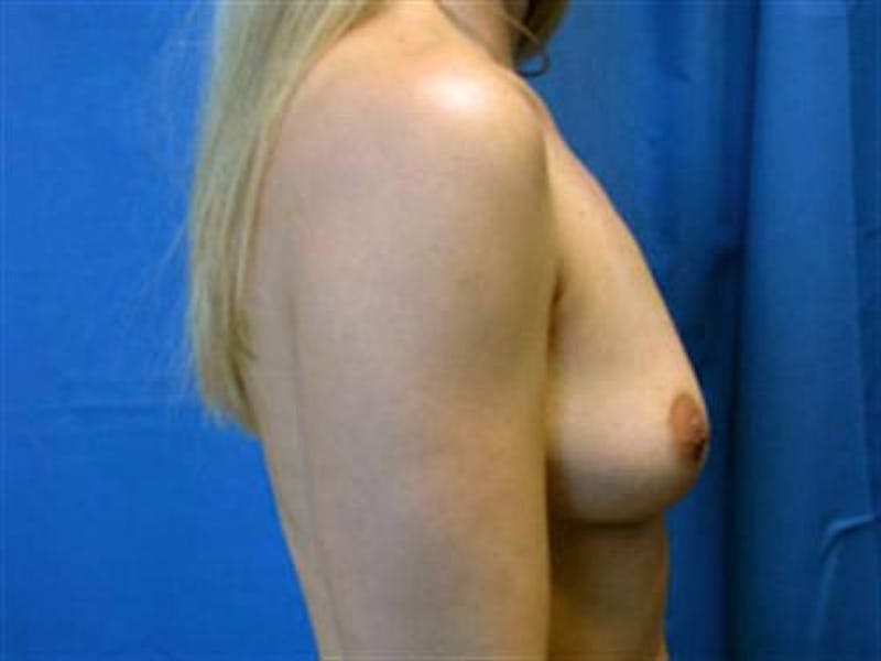 Breast Augmentation Before & After Gallery - Patient 893712 - Image 3